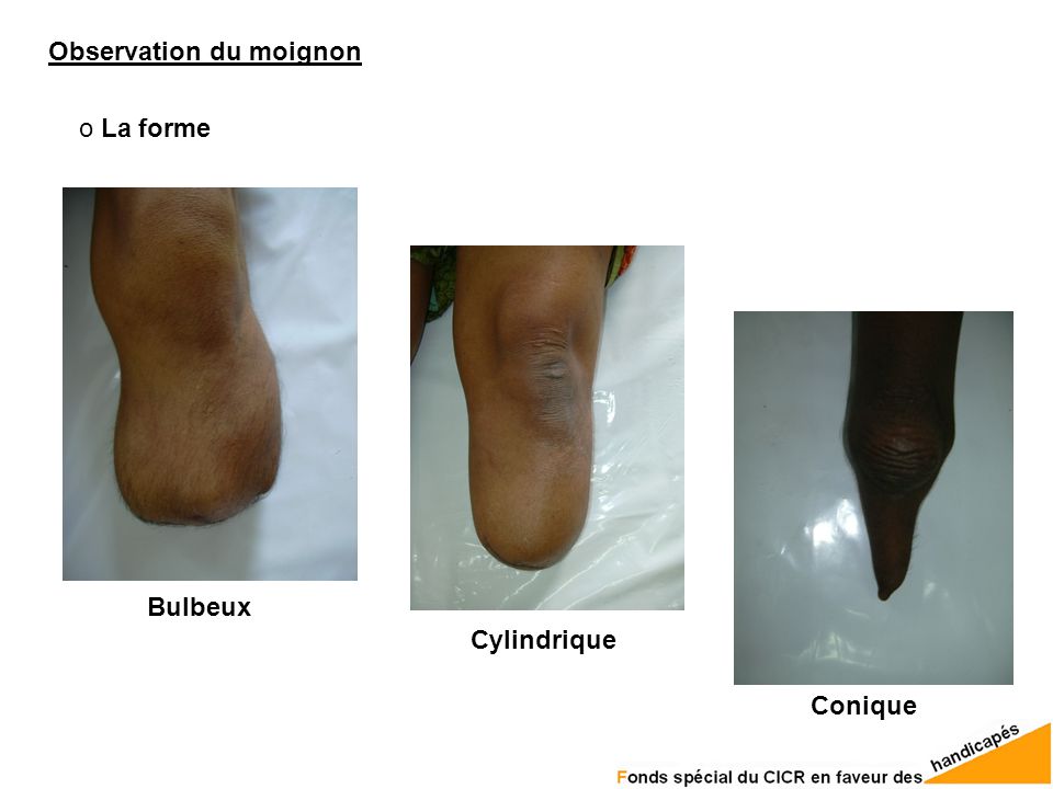 EXAMEN DU PATIENT AVANT APPAREILLAGE ppt video online t l charger